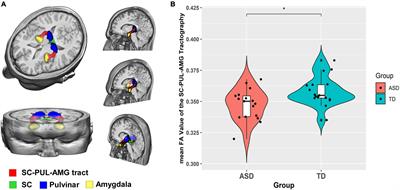 The Impaired Subcortical Pathway From Superior Colliculus to the Amygdala in Boys With Autism Spectrum Disorder